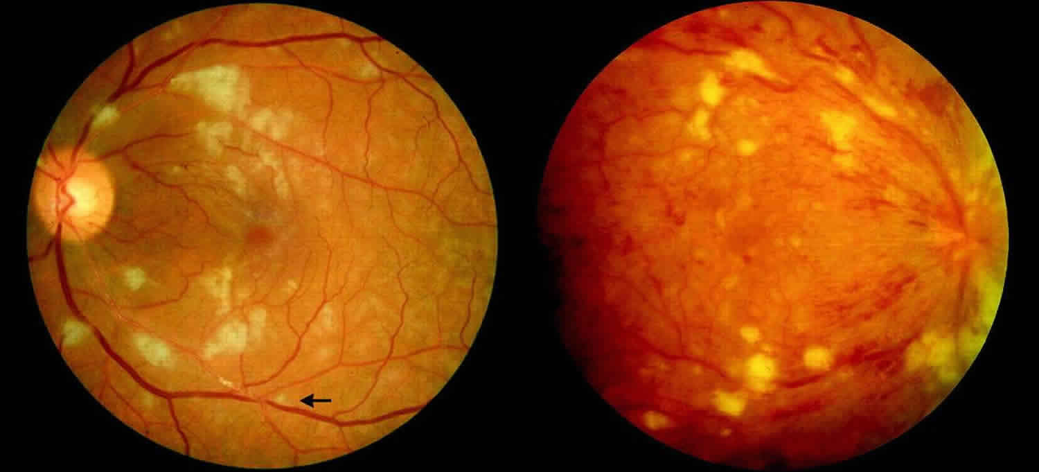Cómo afecta la hepatitis B a sus ojos