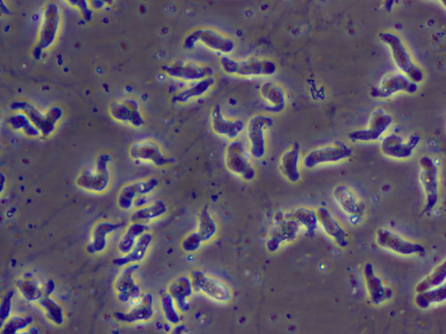 Infección por Naegleria fowleri (ameba devoradora de cerebros)