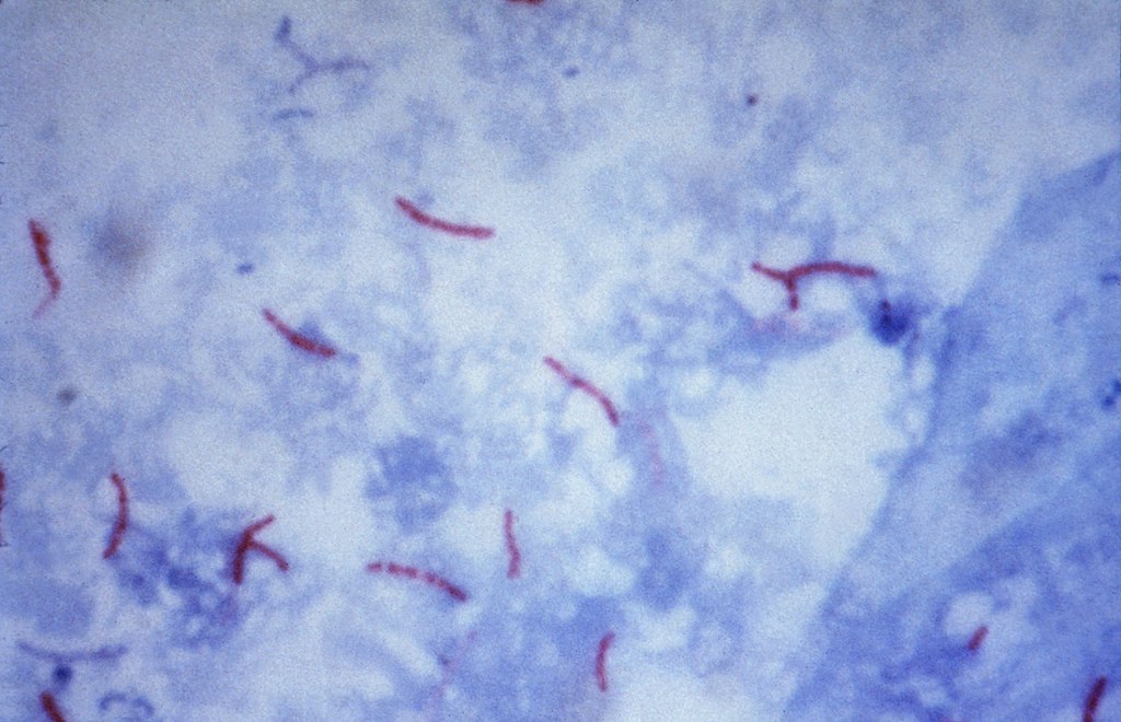 Tinción de Ziehl-Neelsen para Mycobacterium tuberculosis 02.jpg