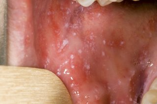 Imagen de manchas de sarampión en la boca