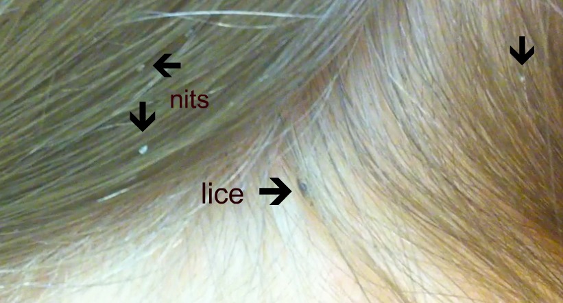 http://medicinabasica.com/wp-content/uploads/2020/12/head-lice-actual.jpg