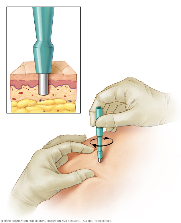 Un médico usa una cuchilla circular especial para eliminar las capas más profundas de piel para su análisis.  Dependiendo del tamaño, pueden ser necesarios puntos de sutura para cerrar la herida.