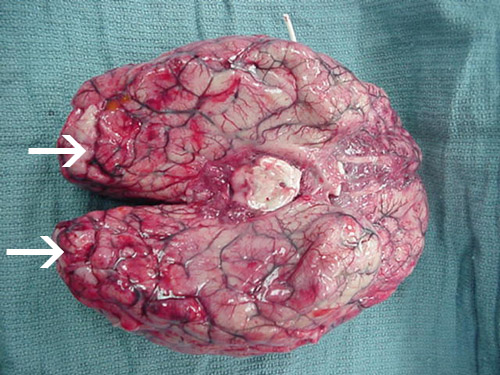 Hay hemorragia y necrosis extensas en el cerebro, principalmente en la corteza frontal.