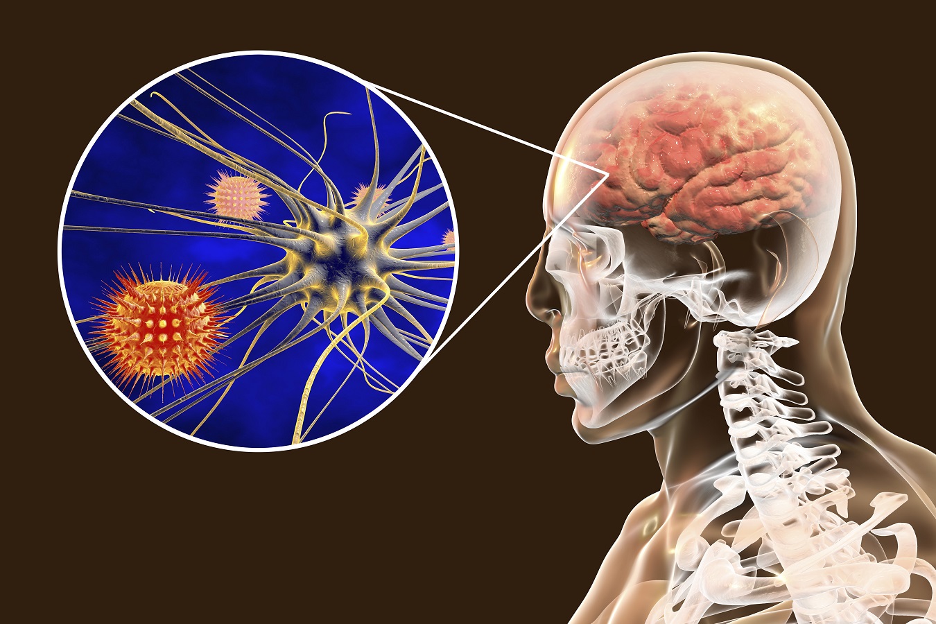 Meningitis bacteriana: síntomas y tratamiento.