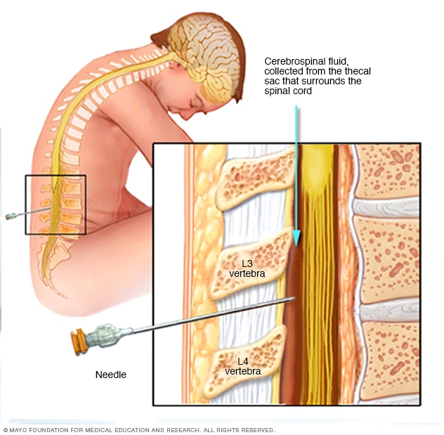 Una aguja extrae líquido del área alrededor de la médula espinal.