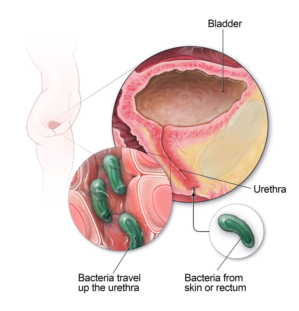 En las mujeres, las bacterias de la piel o el recto pueden viajar por la uretra y causar una infección de la vejiga.